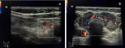 Spontaneous Thyroid Hemorrhage Caused by Langerhans Cell Histiocytosis: A Case Report and Literature Review